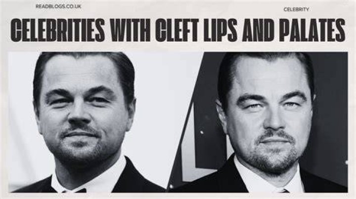 Celebrities With Cleft Lips Telegraph