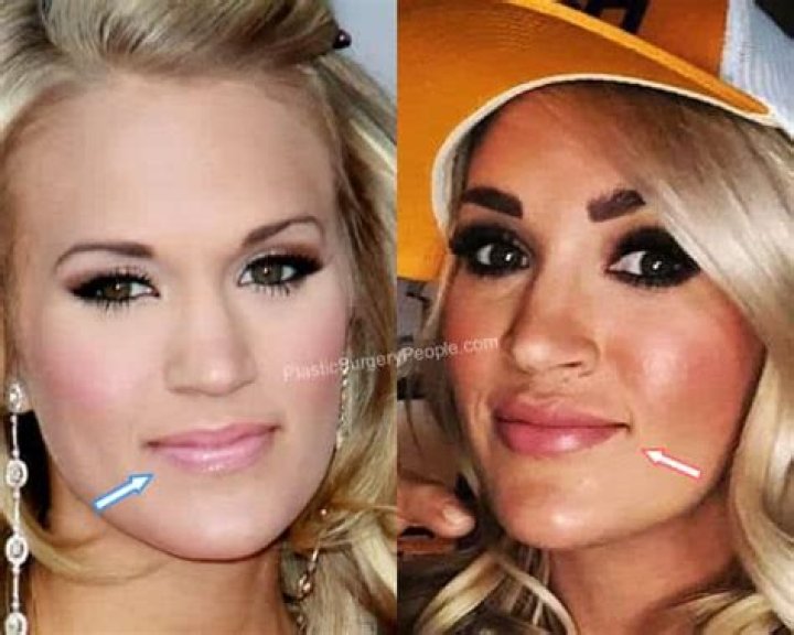 Did Carrie Underwood Get Lip Fillers?