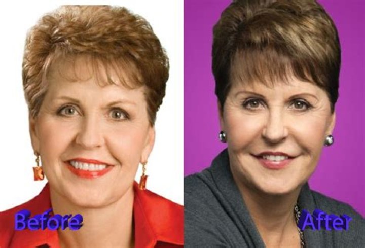 Joyce Meyer lips Surgery VIP