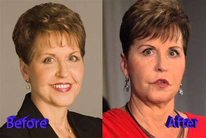 Joyce Meyer Plastic Surgery Before After celebrity plastic surgery