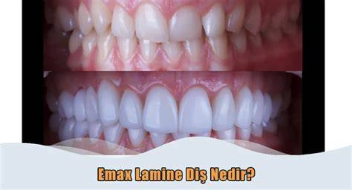 Porselen Lamine Nedir? Ankara Dr. Dt. Ömer Bayar